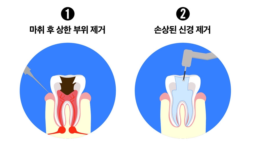 치과치료 치아보험